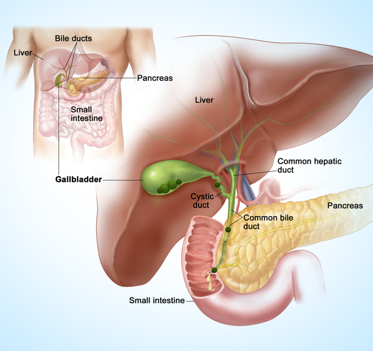 Treatment for Gallstones